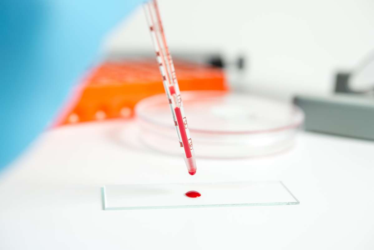 A pipette drops blood on a microscope slide for analysis in a laboratory.